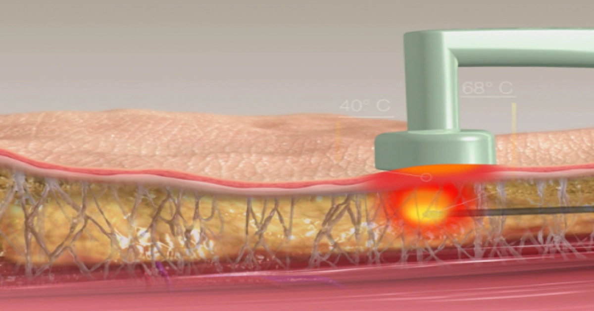 BodyTite™ liefert subkutane Radiofrequenzenergie – Moderne Körperformung mit redeker.ch